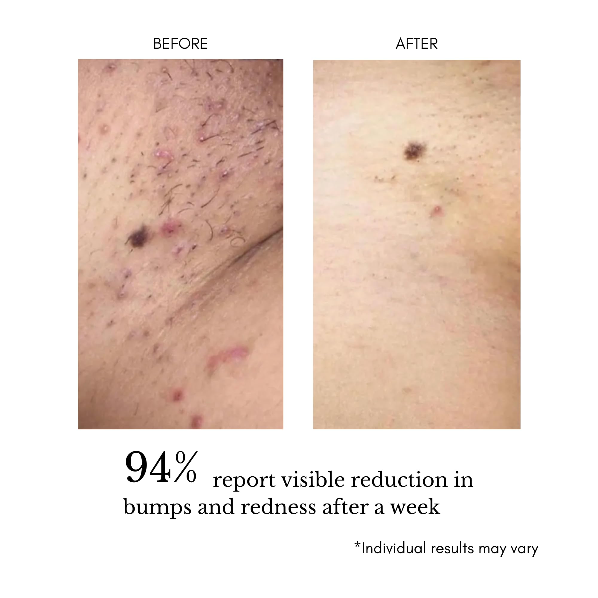 klarifyScience comparación antes y después en línea del bikini, piel más lisa